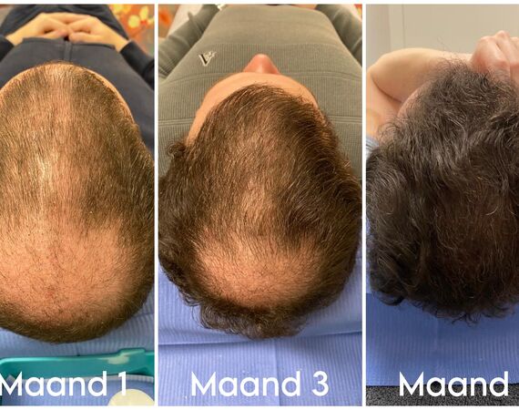 Mesotherapie voor het haar bij Esteworld: een veilige en effectieve behandeling