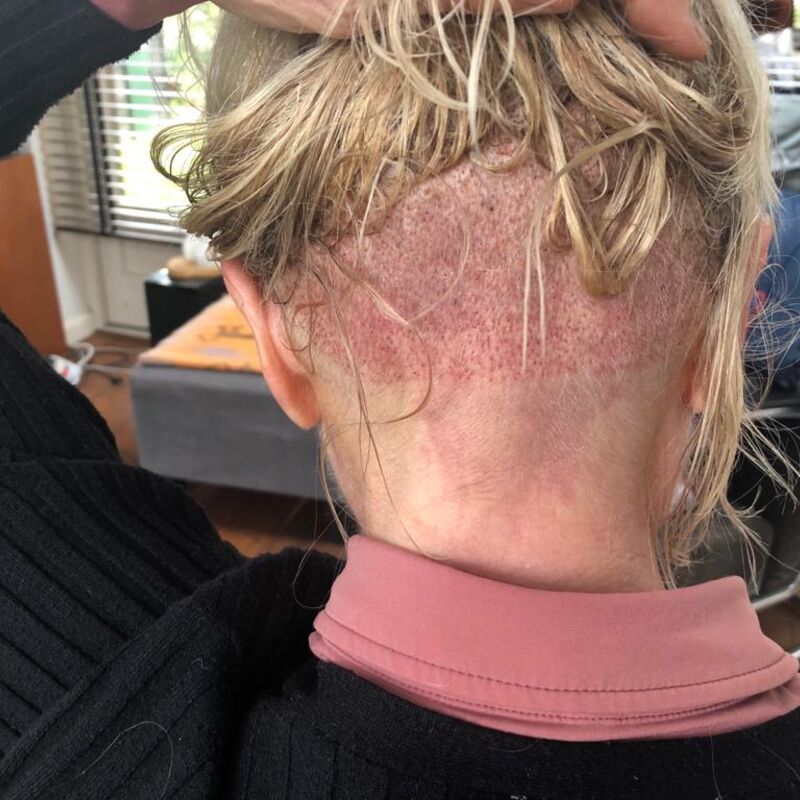 Will, Eerste Haartransplantatie in NL niet goed, nu 2e kans