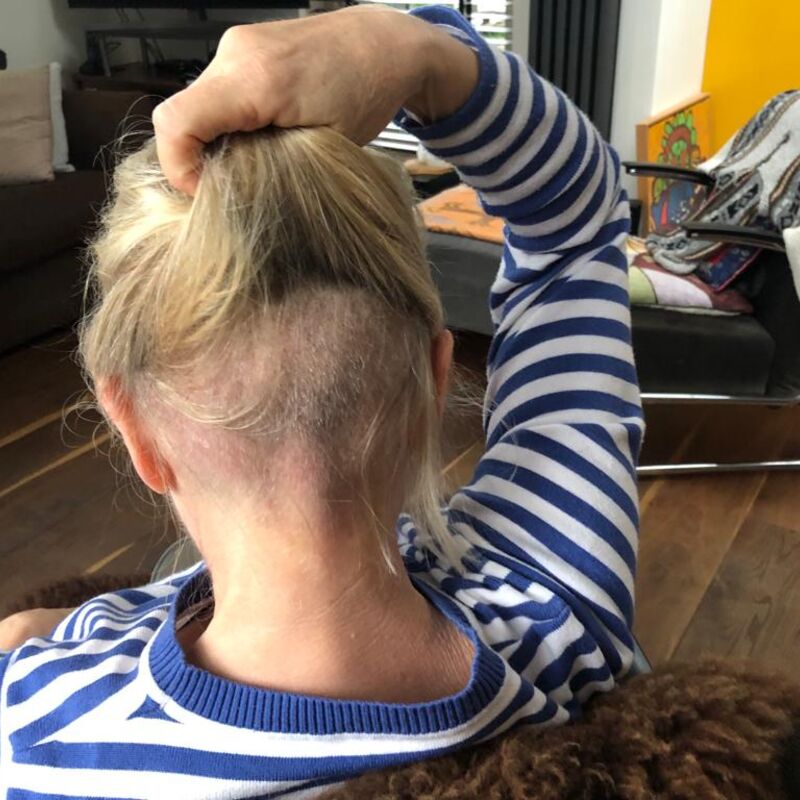 Will, Eerste Haartransplantatie in NL niet goed, nu 2e kans