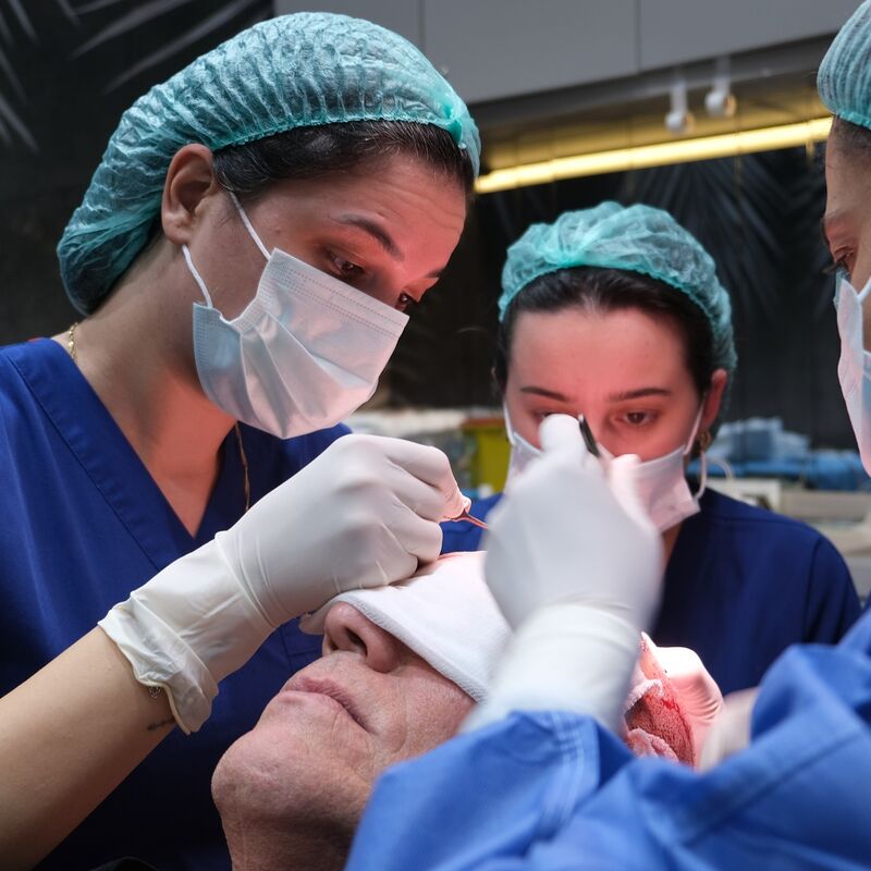 Haartransplantatie ook voor mensen boven de 60